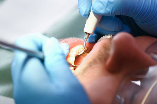 Best Emergency Root Canal Treatment in Mansfield, MO